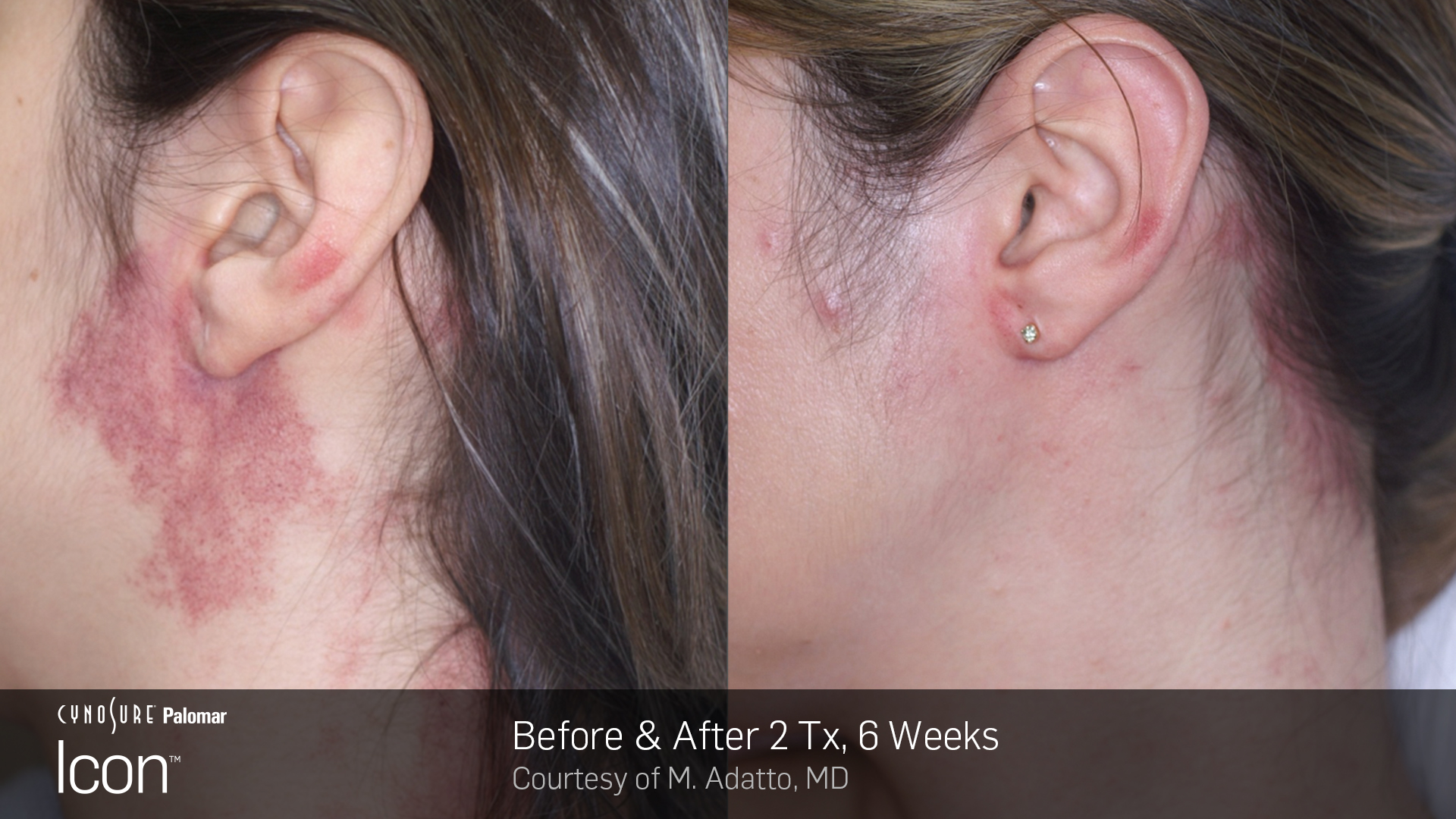 Laser Skin Rejuvenation before and after 4