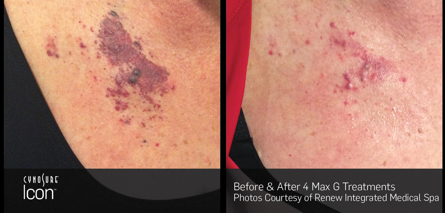 Laser Skin Rejuvenation before and after 3