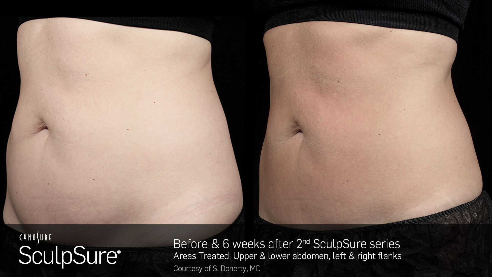 Sculpsure® Non-Invasive Body Contouring before and After #1