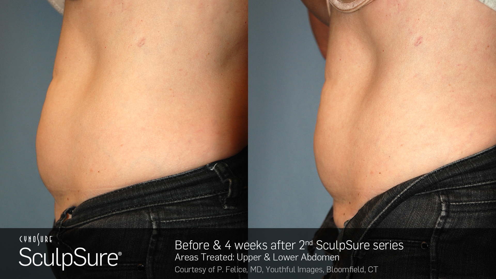 Sculpsure® Non-Invasive Body Contouring before and After #2