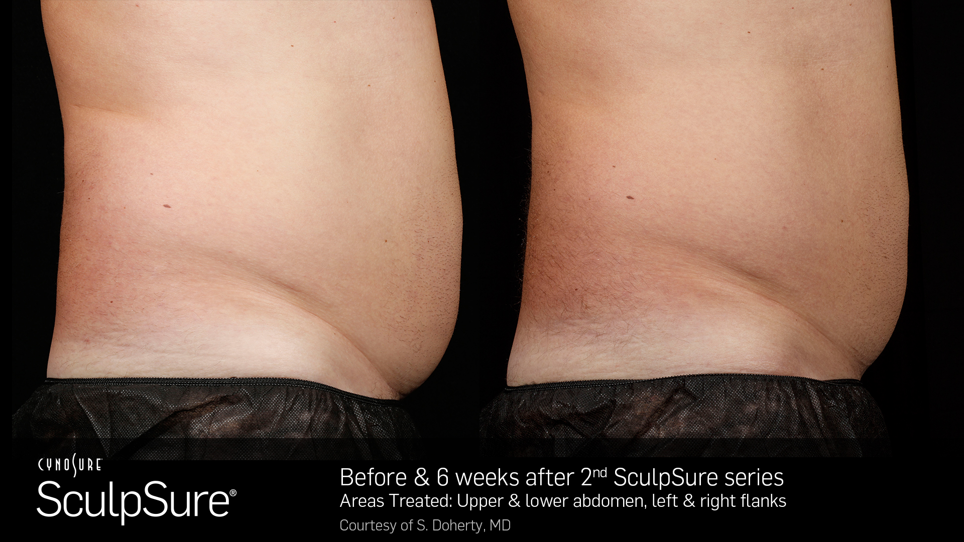 SculpSure Body Contouring