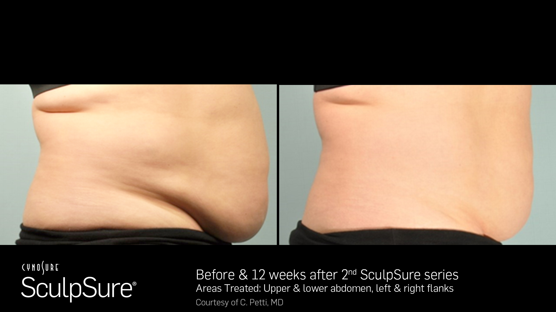 Sculpsure® Non-Invasive Body Contouring before and After #3