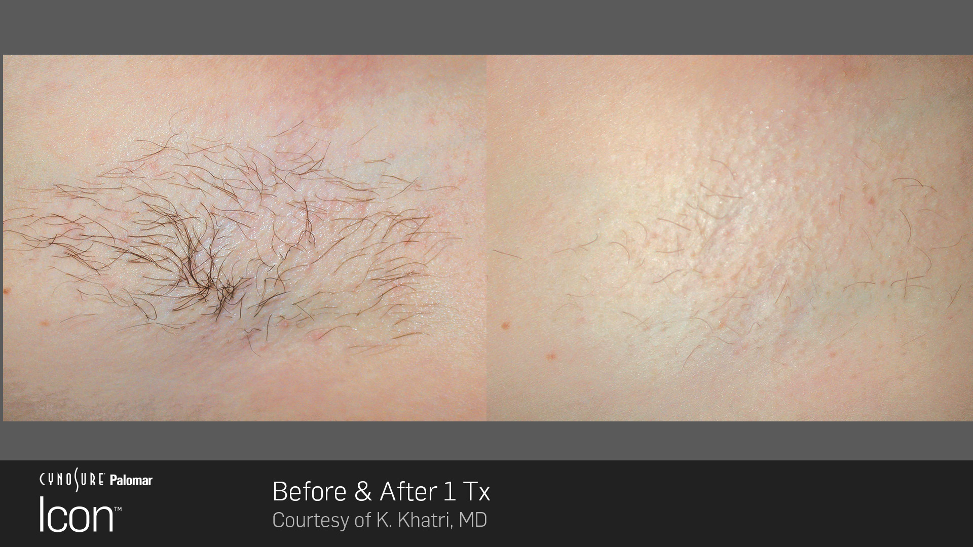 Icon™ Laser Hair Removal before and after #2