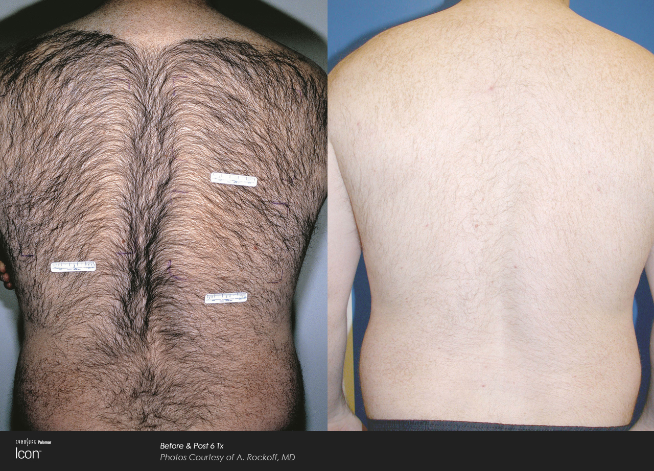 Icon™ Laser Hair Removal before and after #1