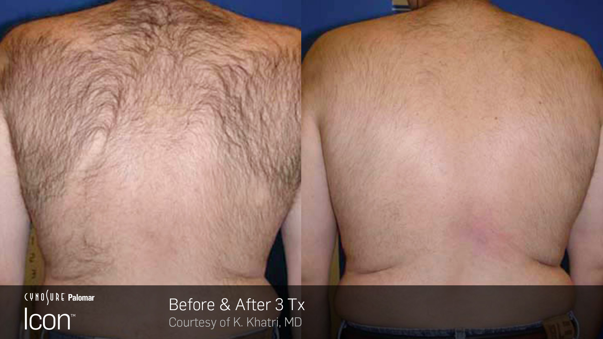 Icon™ Laser Hair Removal before and after #4