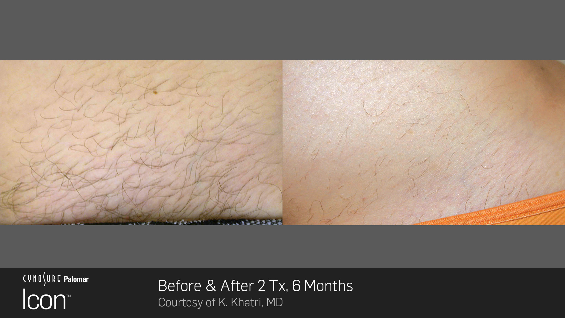 Icon™ Laser Hair Removal before and after #3