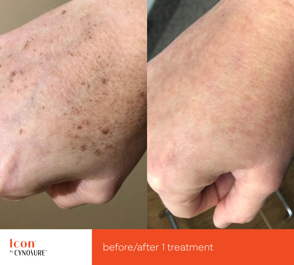 Laser Skin Rejuvenation before and after 2