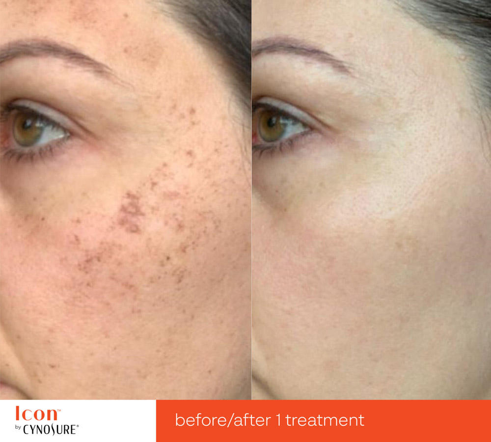 Laser Skin Rejuvenation before and after 1