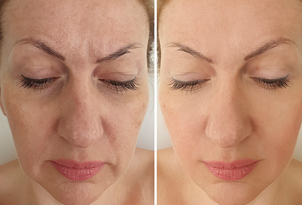 Botox Cosmetic and Xeomin Skin Treatments